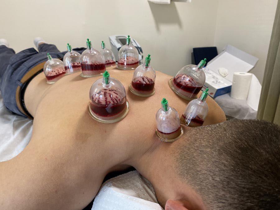 Best Hijama Centre in Afzalgunj, Hyderabad